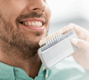 Porcelains veneers