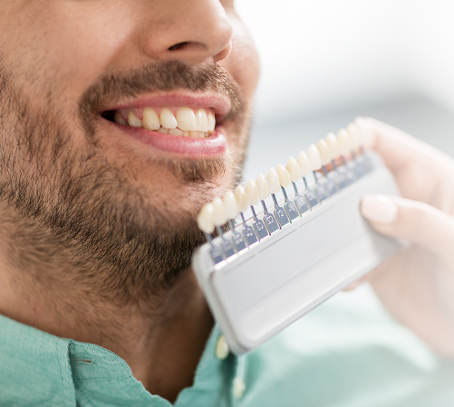 Porcelains veneers