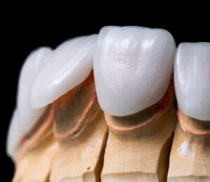 Porcelain Veneers 